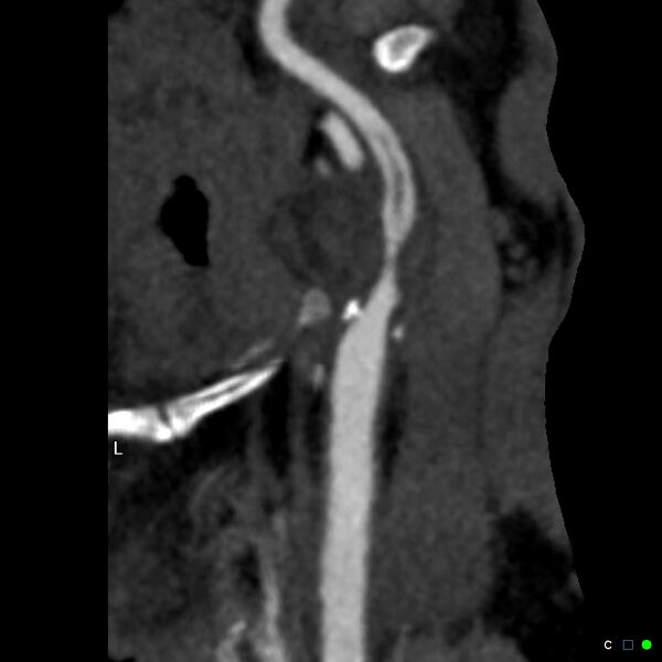File:Non-occlusive intraluminal internal carotid artery thrombus (Radiopaedia 37751-39658 A 45).jpg
