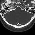 Normal CT of the cervical spine (Radiopaedia 53322-59305 Axial bone window 15).jpg