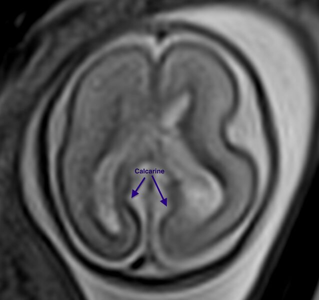 File:Normal brain fetal MRI - 22 weeks (Radiopaedia 50623-56604 Sulcation 2).jpg