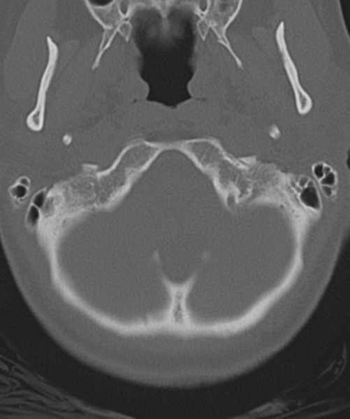 File:Normal cervical spine MRI (including Dixon) (Radiopaedia 42762-45926 Axial bone window 7).png
