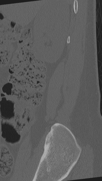 File:Normal lumbar spine CT (Radiopaedia 46533-50986 Sagittal bone window 96).png