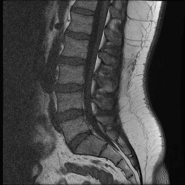 File:Normal lumbar spine MRI (Radiopaedia 43051-46311 Sagittal T1 10).jpg
