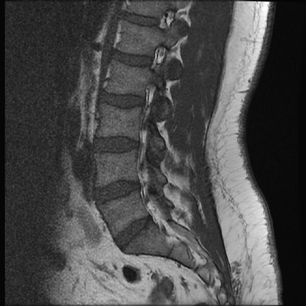 File:Normal lumbar spine MRI (Radiopaedia 43051-46311 Sagittal T1 13).jpg