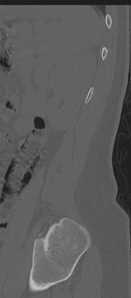 File:Normal lumbosacral CT (Radiopaedia 37923-39867 Sagittal bone window 11).png