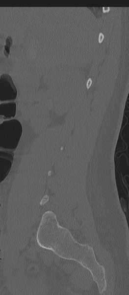 File:Normal lumbosacral CT (Radiopaedia 37923-39867 Sagittal bone window 76).png