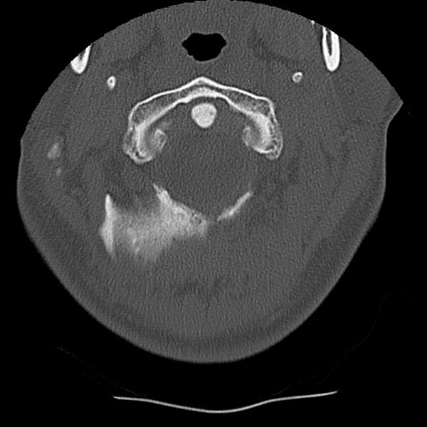 File:Normal trauma spine imaging (Radiopaedia 31753-32686 Axial bone window 7).jpg