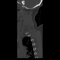 Occipital condyle fracture (Radiopaedia 31755-32691 Sagittal bone window 2).jpg