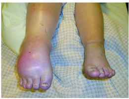 CRPS-1 (Complex regional pain syndrome): dystonic equinus of the right ankle, swollen foot and calf with tightened, pale, gleaming and cold skin.
