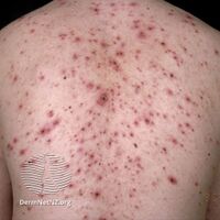 Chicken pox - macules with papules