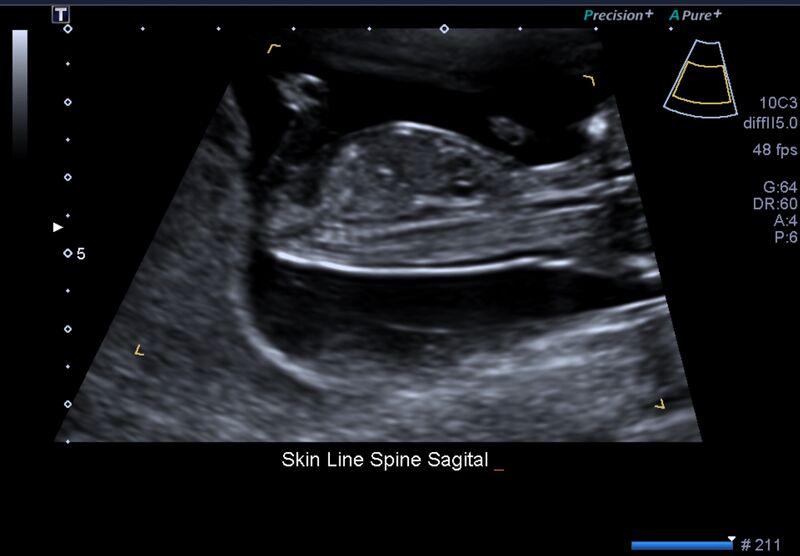 File:1st trimester nuchal-morphology ultrasound (Radiopaedia 44706-48477 General anatomy and NT 37).jpg