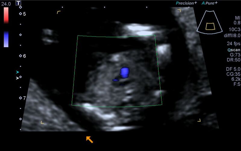 File:1st trimester nuchal-morphology ultrasound (Radiopaedia 44706-48477 Heart views cine with colour 138).jpg
