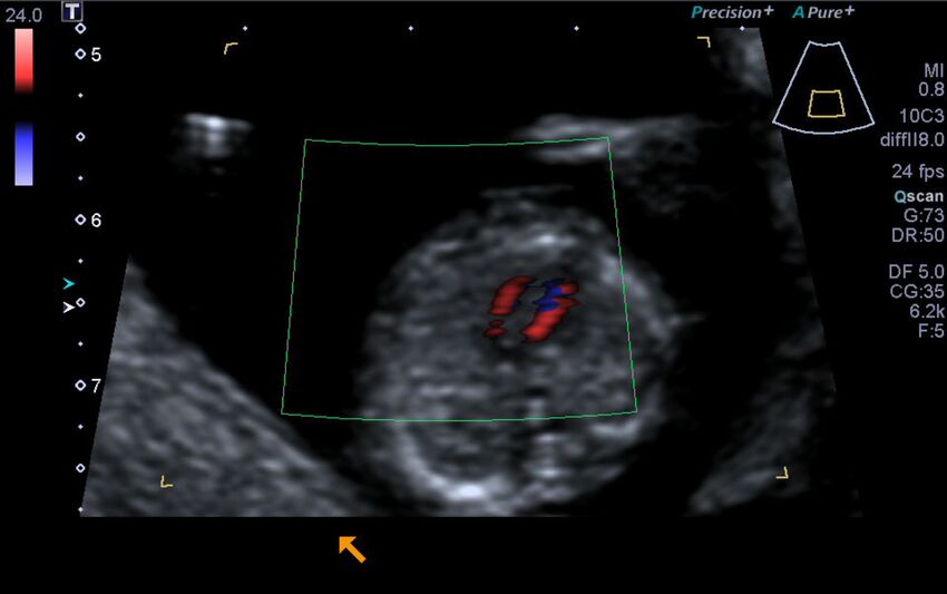 1st trimester nuchal-morphology ultrasound (Radiopaedia 44706-48477 Heart views cine with colour 94).jpg