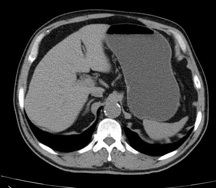 File:Abdominal aortic aneurysm (Radiopaedia 22421-22458 non-contrast 11).jpg