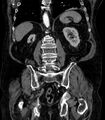 Abdominal aortic aneurysm (Radiopaedia 25855-26001 Coronal C+ arterial phase 55).jpg