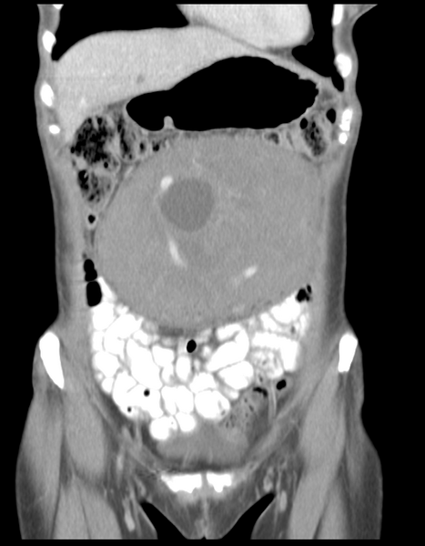 File:Abdominal desmoid tumor (Radiopaedia 41007-43740 Coronal C+ portal venous phase 11).png