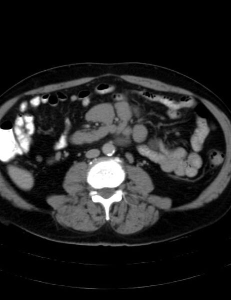 File:Abdominal lymphoma - with sandwich sign (Radiopaedia 53486-59492 Axial C+ portal venous phase 28).jpg