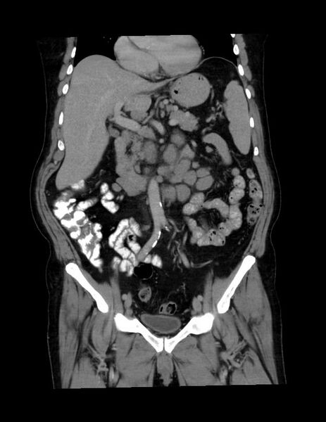 File:Abdominal lymphoma - with sandwich sign (Radiopaedia 53486-59492 C+ portal venous phase 32).jpg