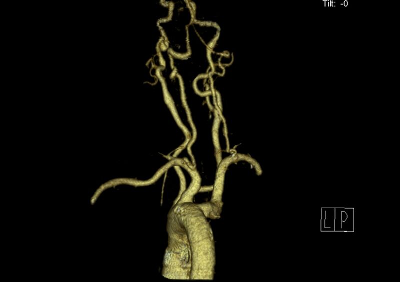 File:Aberrant right subclavian artery (Radiopaedia 19283-19294 3D reconstruction C+ arterial phase 19).jpg