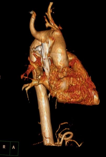 File:Aberrant right subclavian artery (Radiopaedia 67135-76475 B 18).jpg
