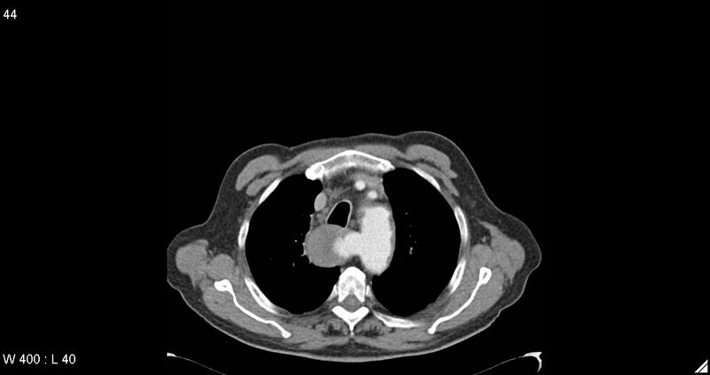File:Aberrant right subclavian artery aneurysm (Radiopaedia 13747-13631 Axial C+ arterial phase 21).jpg
