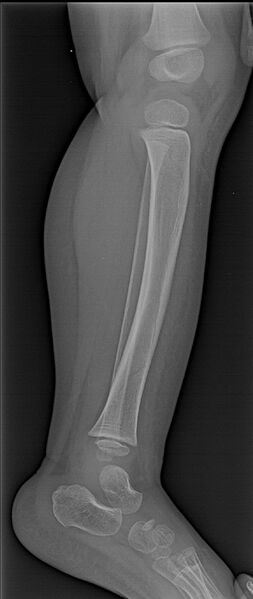 File:Accidental or innocent toddler fracture (Radiopaedia 49764-55024 Lateral 1).jpg