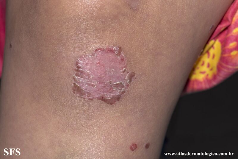 File:Acrodermatitis Enteropathica (Dermatology Atlas 51).jpg