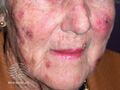Actinic Keratoses treated with imiquimod (DermNet NZ lesions-ak-imiquimod-3746).jpg