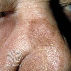 Actinic keratosis (DermNet NZ lesions-s-pigmented-sk2).jpg