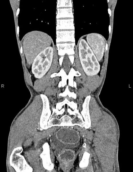 File:Active crohn disease (Radiopaedia 87133-103397 Coronal C+ arterial phase 51).jpg