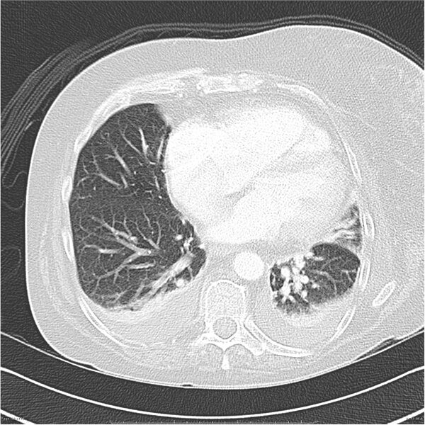 File:Acute-on-chronic pulmonary emboli (Radiopaedia 27925-28169 lung window 32).jpg