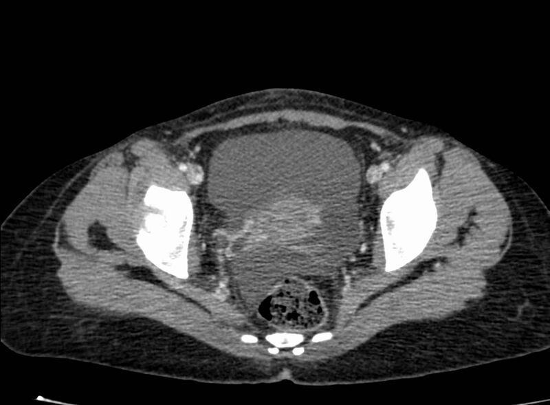 File:Acute Budd-Chiari syndrome (Radiopaedia 60858-68638 Axial C+ portal venous phase 270).jpg