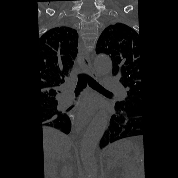 File:Acute and chronic vertebral compression fractures (Radiopaedia 31608-32494 Coronal bone window 8).jpg