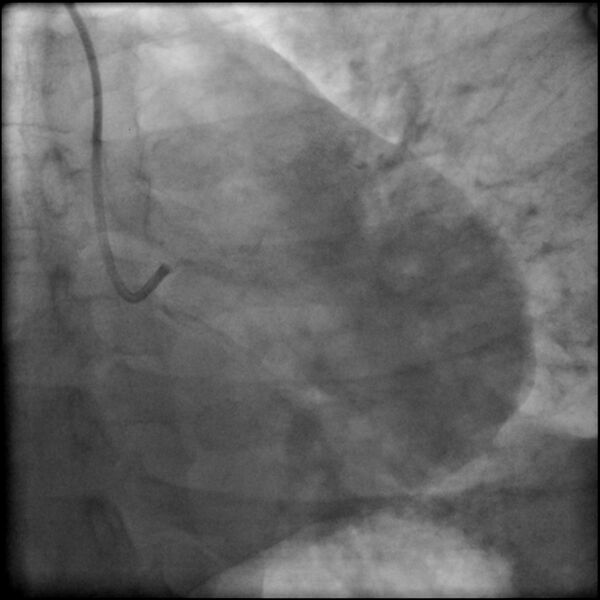 File:Acute anteroseptal myocardial infarction (Radiopaedia 68409-77946 LAO caudal (spider view) LAD and CX 3).jpg