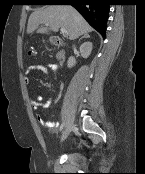 File:Acute mesenteric venous ischemia (Radiopaedia 46041-50383 Sagittal C+ portal venous phase 45).jpg