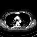 Acute myocardial infarction in CT (Radiopaedia 39947-42415 Axial C+ arterial phase 43).jpg