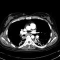 Acute myocardial infarction in CT (Radiopaedia 39947-42415 Axial C+ arterial phase 65).jpg