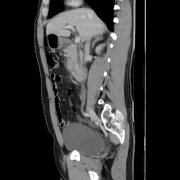 File:Acute pancreatitis (Radiopaedia 22572-22596 Sagittal C+ portal venous phase 22).jpg