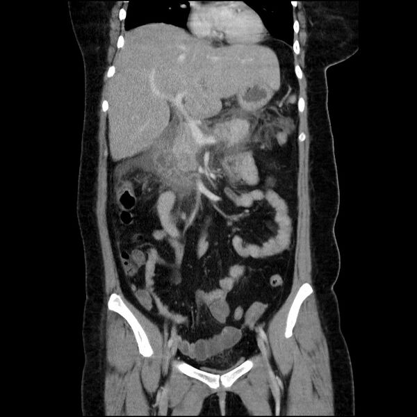 File:Acute pancreatitis (Radiopaedia 69236-79012 Coronal C+ portal venous phase 44).jpg