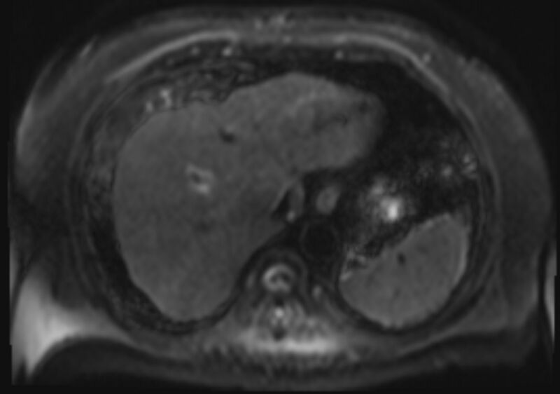 File:Acute portal vein thrombosis (Radiopaedia 73198-83925 Axial DWI 10).jpg
