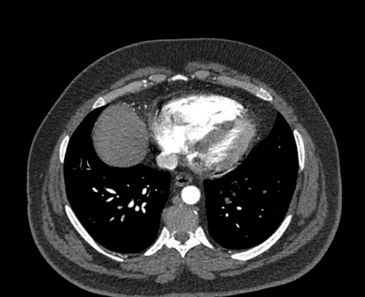 File:Acute pulmonary embolism with pulmonary infarcts (Radiopaedia 77688-89908 Axial C+ CTPA 48).jpg