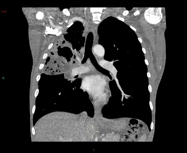 File:Acute right lung abscess (Radiopaedia 34806-36258 Coronal C+ arterial phase 28).jpg