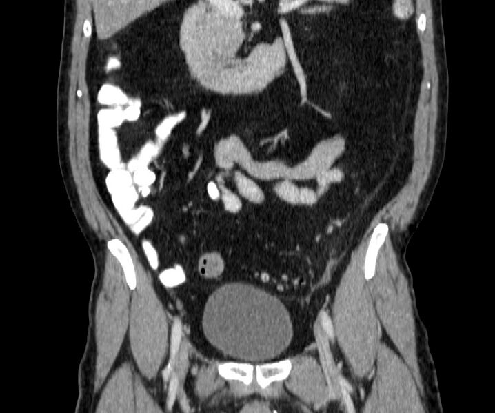 File:Acute sigmoid colon diverticulitis (Radiopaedia 55507-61976 Coronal C+ portal venous phase 66).jpg