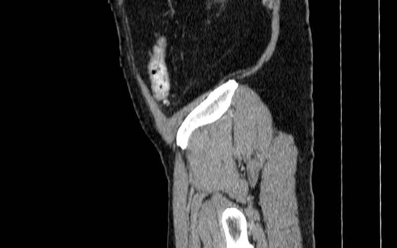 File:Acute sigmoid colon diverticulitis (Radiopaedia 55507-61976 Sagittal C+ portal venous phase 131).jpg