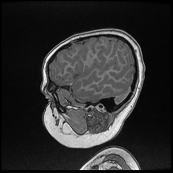 File:Adamantinomatous craniopharyngioma (Radiopaedia 77407-89529 Sagittal T1 C+ 22).jpg