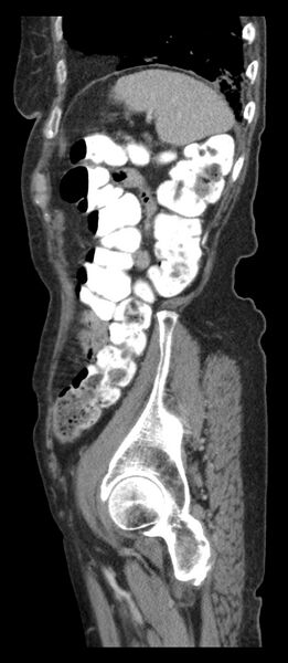 File:Adenocarcinoma of cecum (Radiopaedia 59222-66549 Sagittal C+ portal venous phase 11).jpg