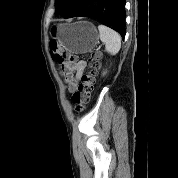 File:Adenocarcinoma of colon with entero-colic fistula (Radiopaedia 22832-22852 Sagittal C+ portal venous phase 55).jpg