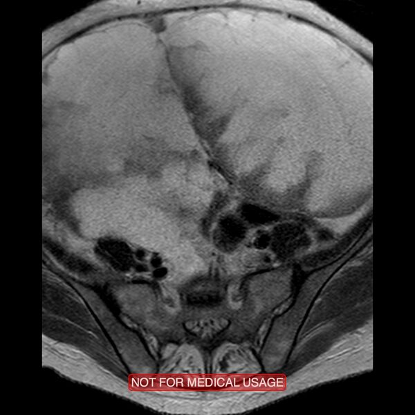 File:Adenocarcinoma of the cervix (Radiopaedia 28373-28615 Axial T2 21).jpg