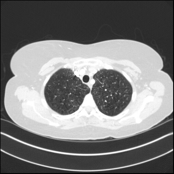 File:Adenocarcinoma of the lung (Radiopaedia 44205-47803 Axial lung window 21).jpg