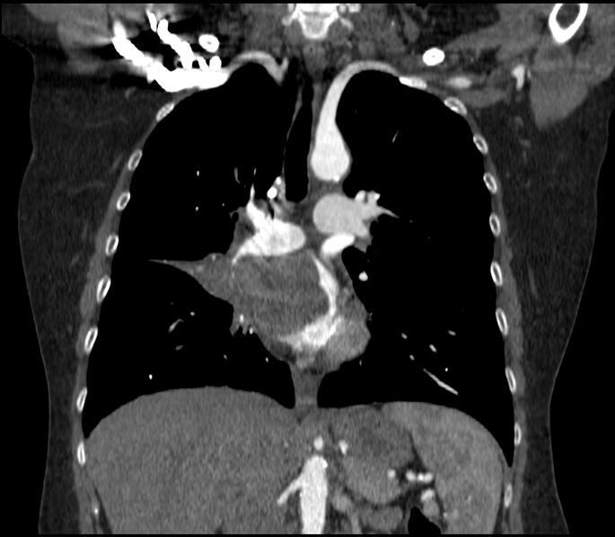 File:Adenocarcinoma of the lung (Radiopaedia 44205-47803 Coronal C+ portal venous phase 45).jpg