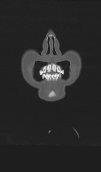 File:Adenoid cystic tumor of palate (Radiopaedia 46980-51518 Coronal bone window 9).png